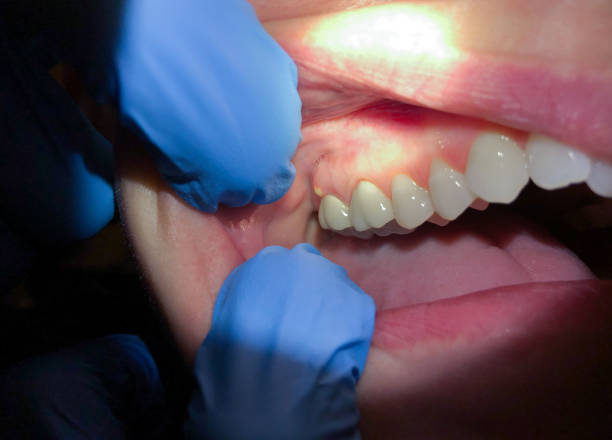 Best Emergency Root Canal Treatment in Rosemont, PA